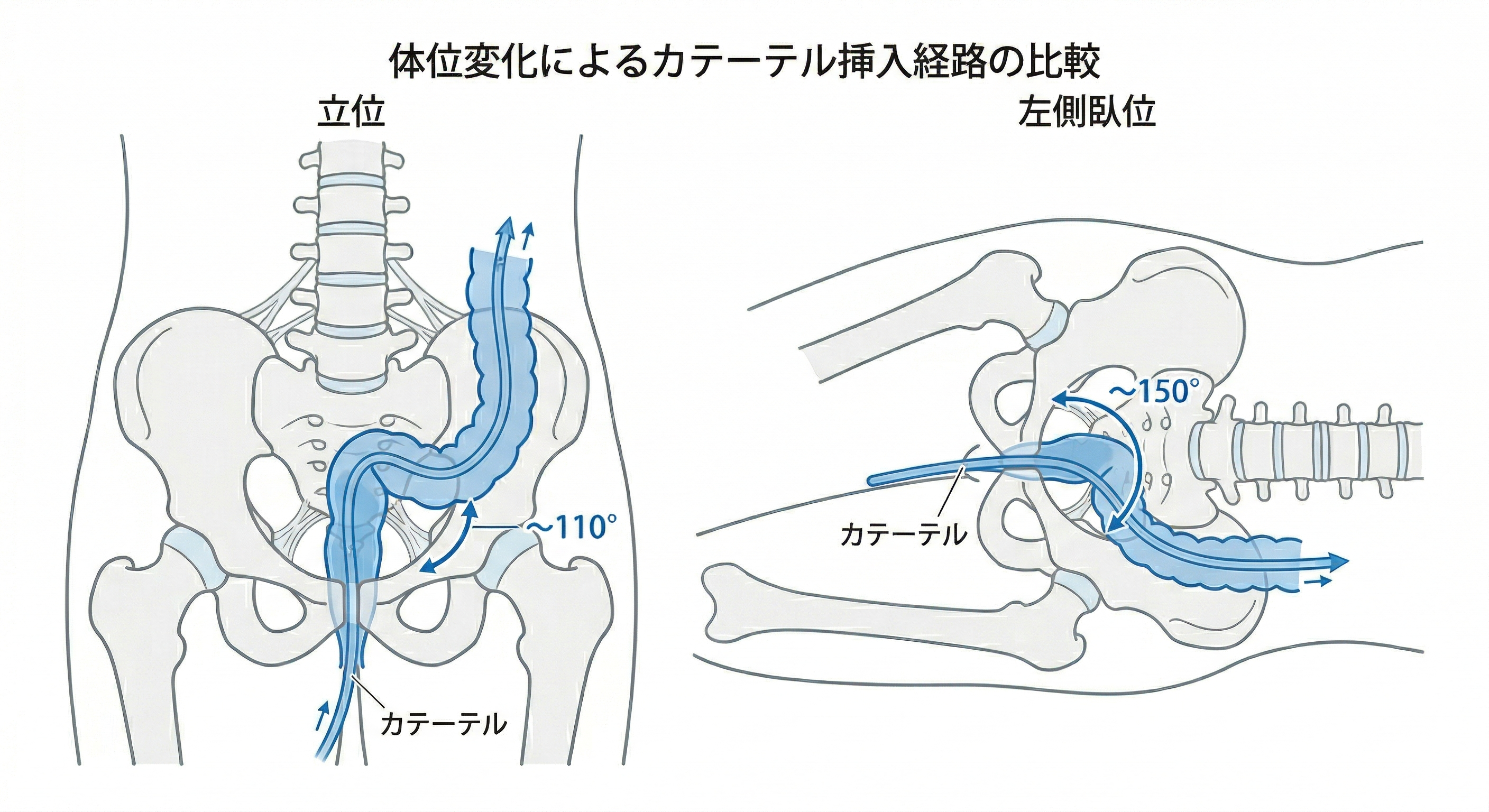立位と左側臥位におけるカテーテル挿入経路の比較図