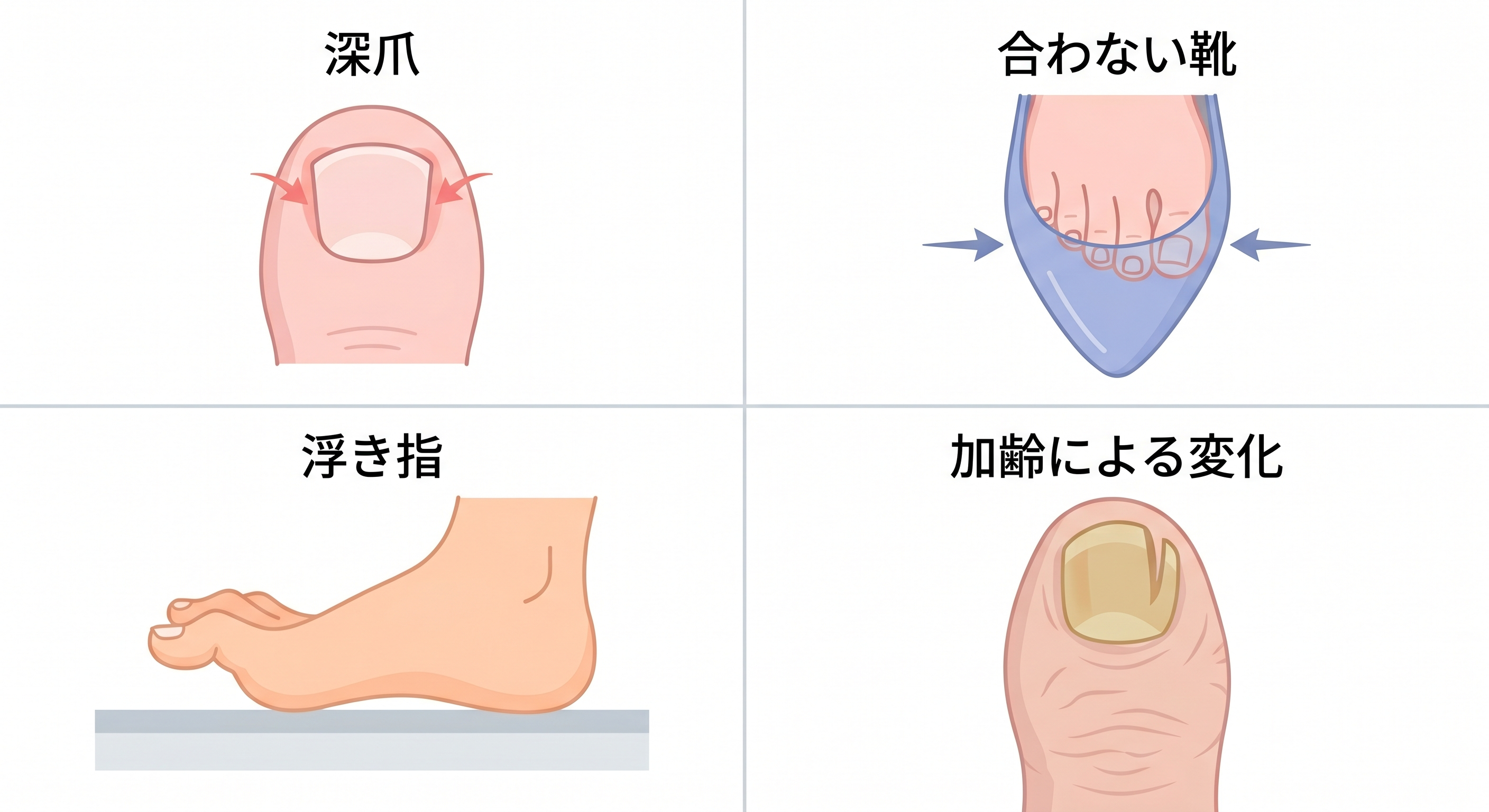 巻き爪の主な原因(深爪・合わない靴・浮き指・加齢による変化)