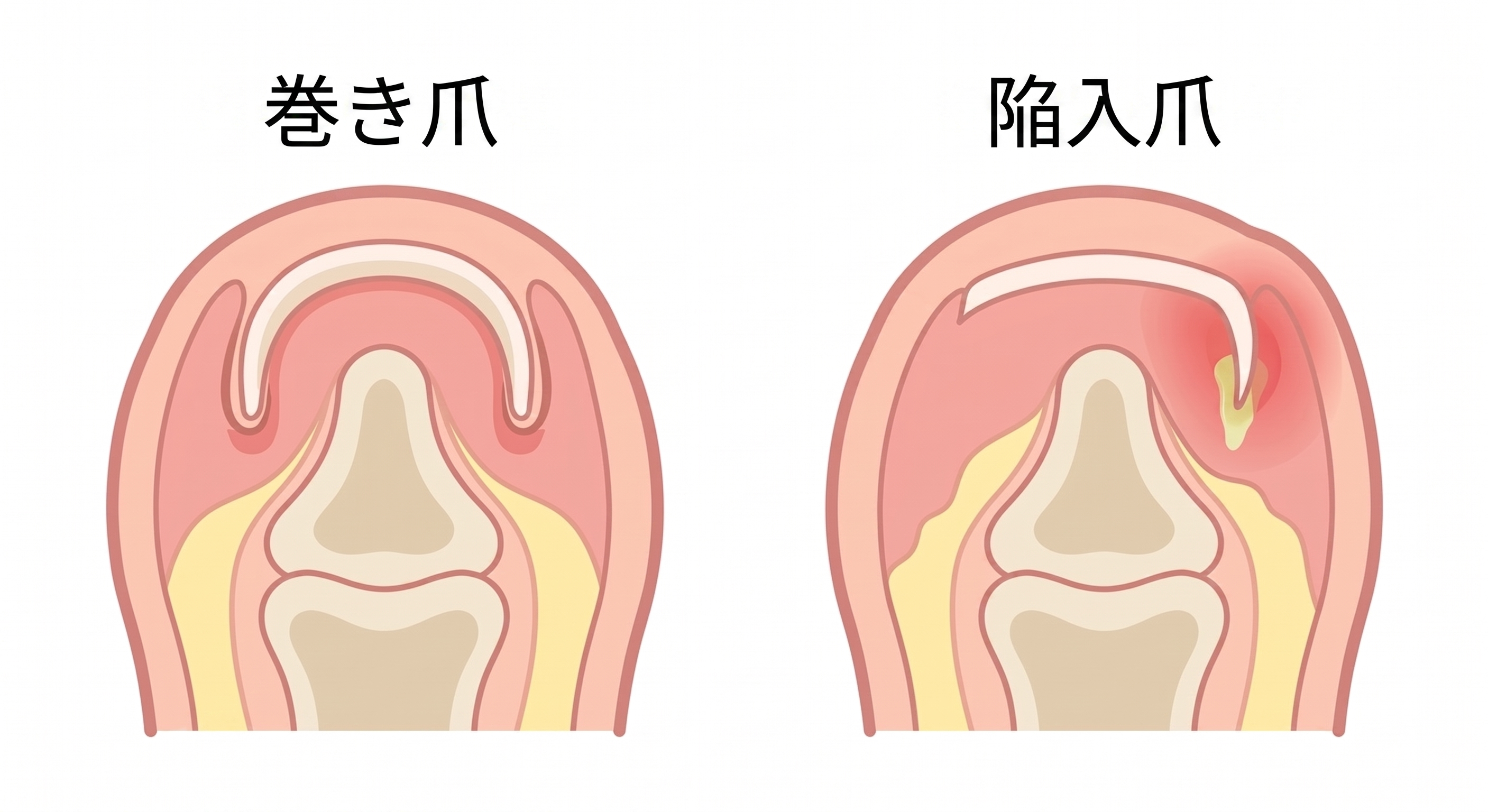 巻き爪と陥入爪の違いを示す断面イラスト